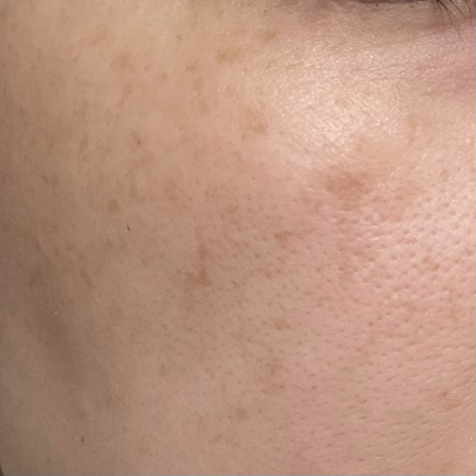 しみ取りレーザー施術前の肌の状態（洗顔後・化粧水のみ）