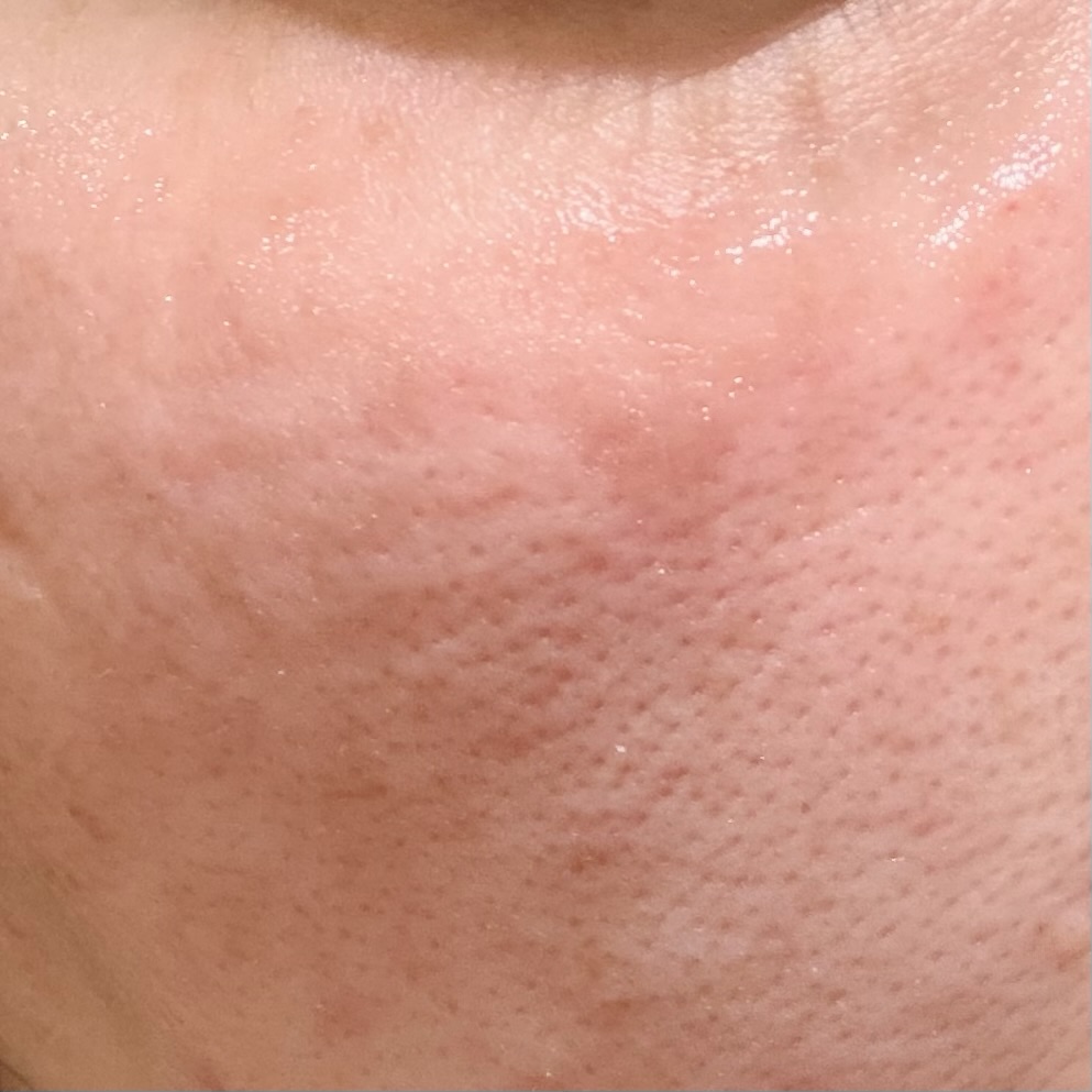 しみ取りレーザー照射直後の赤みが出ている肌の様子