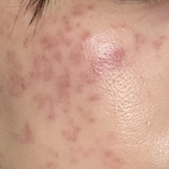 しみ取りレーザー後、帰宅して少し落ち着いた肌の様子