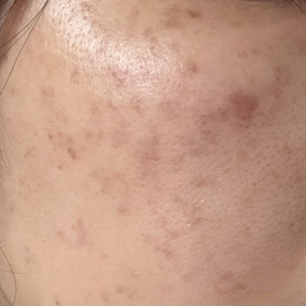 しみ取りレーザー翌日1日目の肌の変化