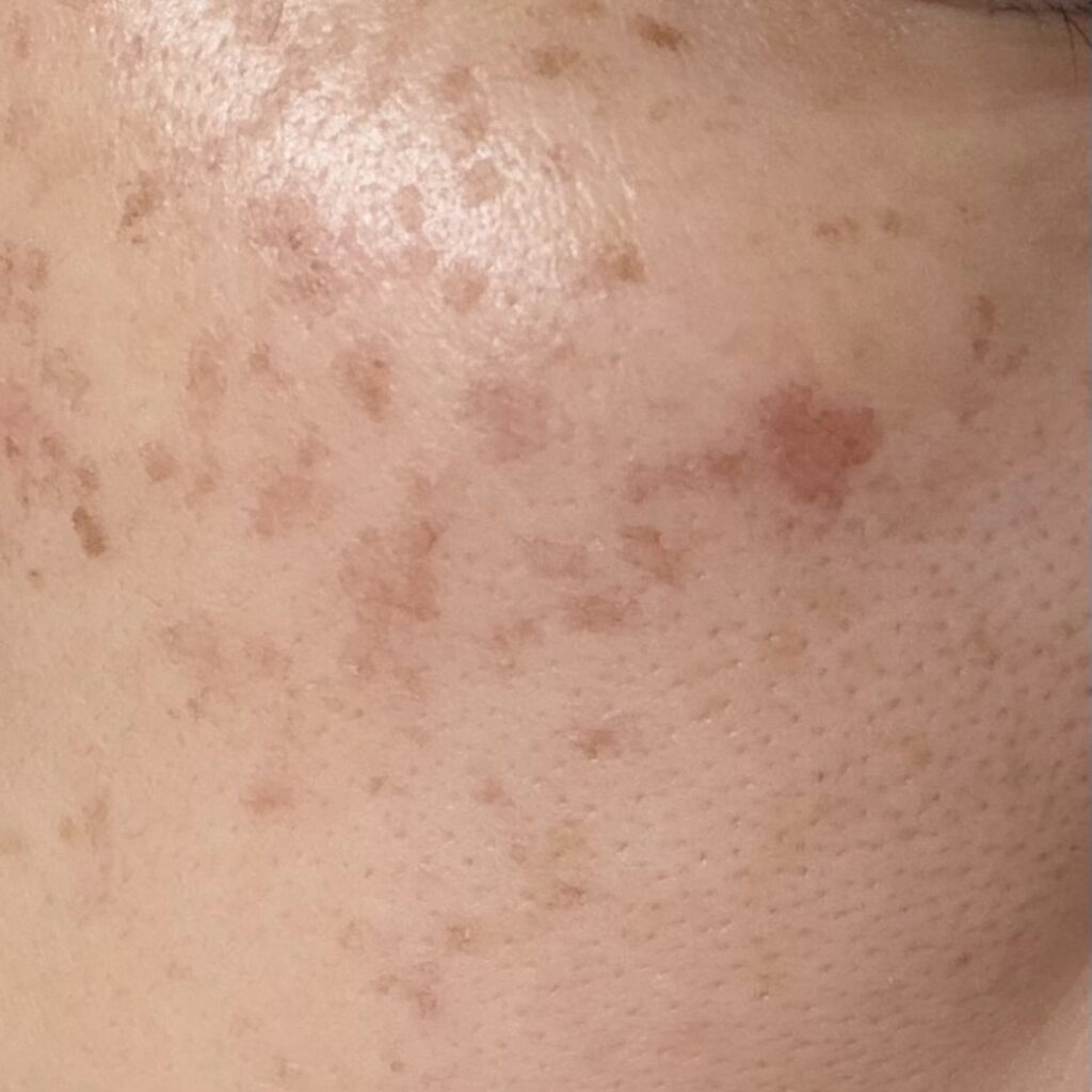 しみ取りレーザー照射から3日目の経過写真